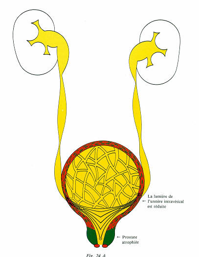 atrophie prostate tension des reins